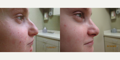 Rhinoplasty before and after photo