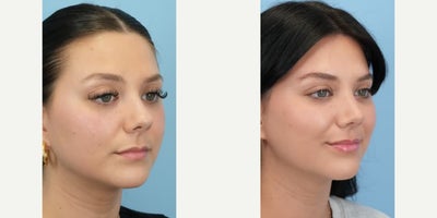 Rhinoplasty before and after photo
