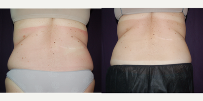 SculpSure before and after photo