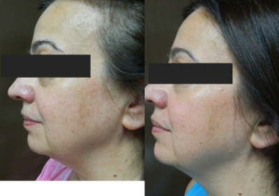 Ultherapy before and after photo