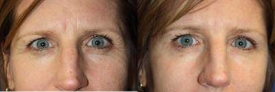 Botox before and after photo