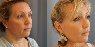 Facelift before and after photo