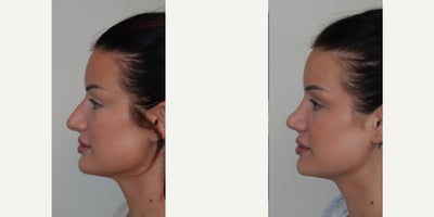 Rhinoplasty before and after photo