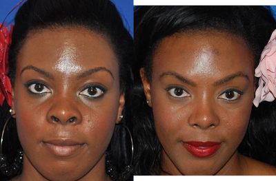 African American Rhinoplasty before and after photo