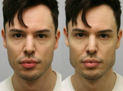 Dermal Fillers before and after photo
