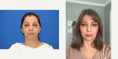 SMAS Facelift before and after photo