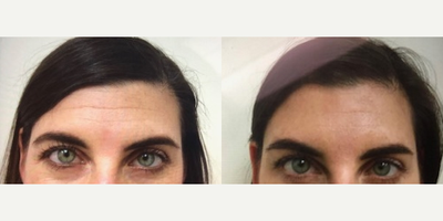 Botox before and after photo