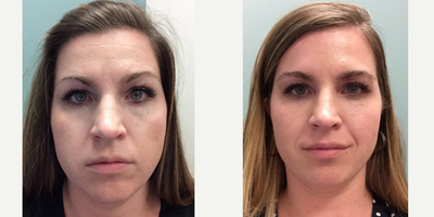 Bellafill before and after photo