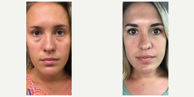Belotero before and after photo