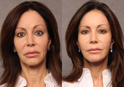 Facelift before and after photo