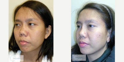 Asian Rhinoplasty before and after photo