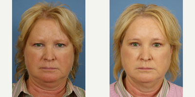 Brow Lift before and after photo