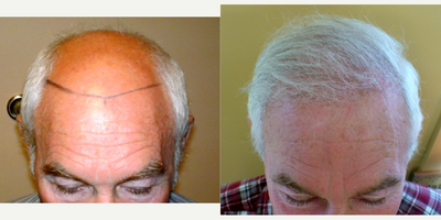 Hair Transplant before and after photo