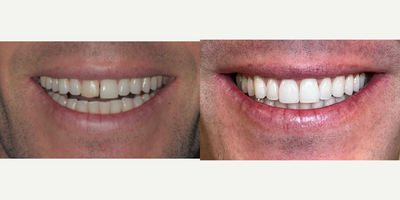 Invisalign before and after photo