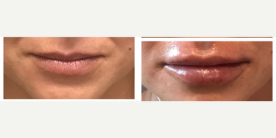 Juvederm before and after photo