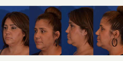 Revision Rhinoplasty before and after photo