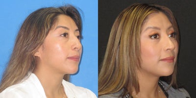 Rhinoplasty before and after photo