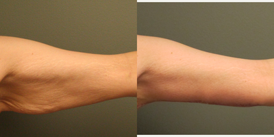 Arm Lift before and after photo