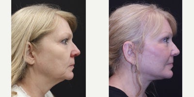 Brow Lift before and after photo
