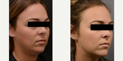 Kybella before and after photo