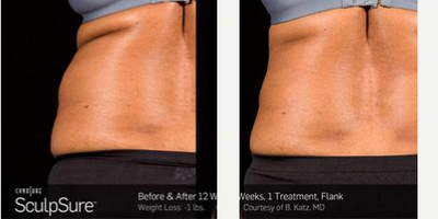 SculpSure before and after photo