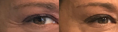 Botox before and after photo
