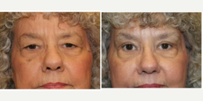 Eyelid Surgery before and after photo