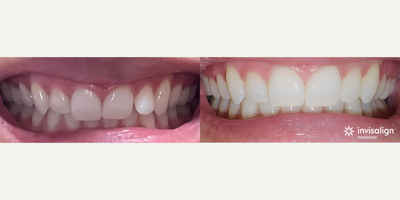 Invisalign before and after photo