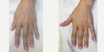 Radiesse before and after photo