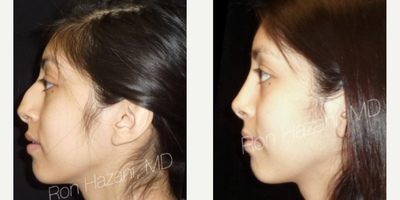 Rhinoplasty before and after photo
