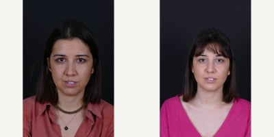 Buccal Fat Removal before and after photo