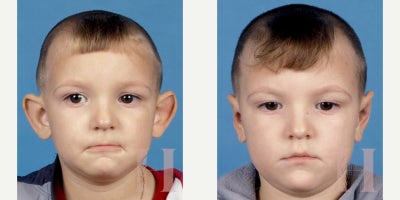 Ear Surgery before and after photo