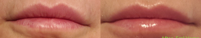 Lip Fillers before and after photo