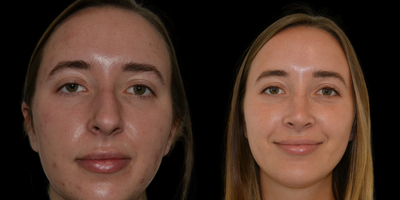 Rhinoplasty before and after photo