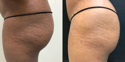 Brazilian Butt Lift before and after photo