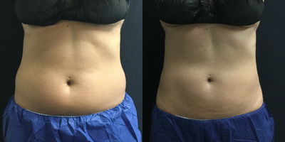 CoolSculpting before and after photo