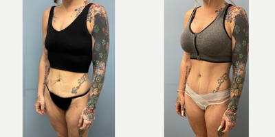 Tummy Tuck before and after photo
