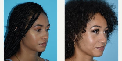 African American Rhinoplasty before and after photo