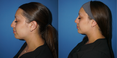 Dermal Fillers before and after photo