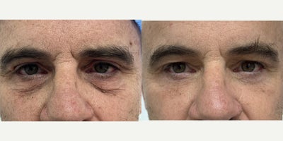 Eyelid Surgery before and after photo