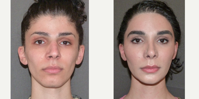 Facial Feminization Surgery before and after photo