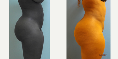 Liposuction before and after photo