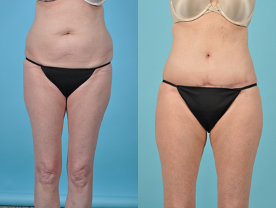 Tummy Tuck before and after photo