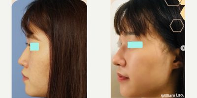 Asian Rhinoplasty before and after photo