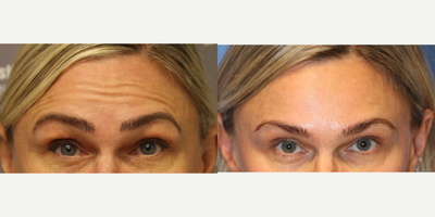 Botox before and after photo