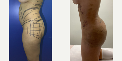 Brazilian Butt Lift before and after photo
