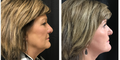 FaceTite before and after photo
