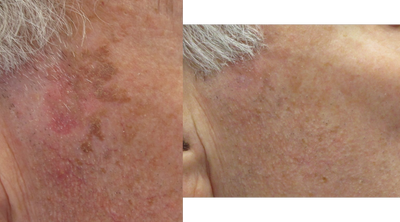 Laser Resurfacing before and after photo