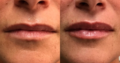 Lip Fillers before and after photo