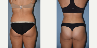 Liposuction before and after photo